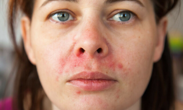 RØDE NUPPER PÅ RØD BUNN: Typisk utslett ved perioral dermatitt hos kvinne i 40-årene. FOTO: NTB Scanpix / Shutterstock RØDE NUPPER PÅ RØD BUNN: Typisk utslett ved perioral dermatitt hos kvinne i 40-årene. FOTO: NTB Scanpix / Shutterstock